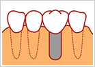 インプラント