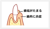 歯垢がたまる　歯肉に炎症