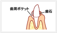 歯周ポケット　歯石