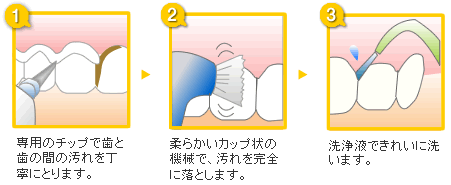 専用のチップで歯と歯の間の汚れを丁寧にとります。柔らかいカップ状の機械で、汚れを完全に落とします。洗浄液できれいに洗います。