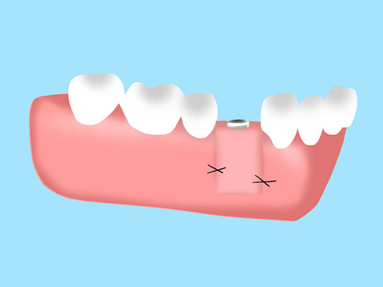 インプラント埋入手術 STEP 3