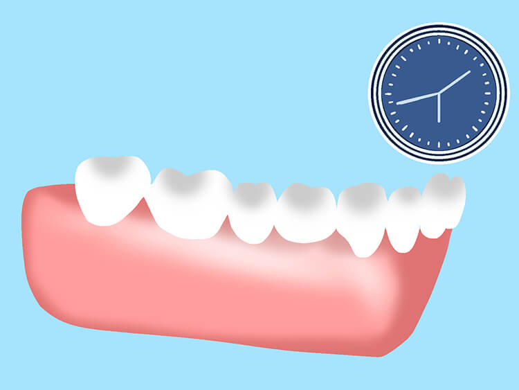 インプラント埋入手術 STEP 4