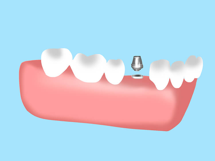 インプラント埋入手術 STEP 5