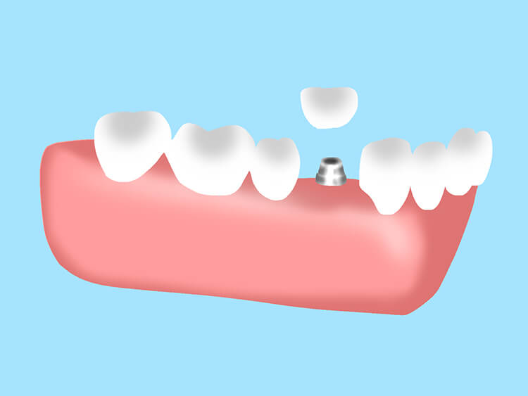 インプラント埋入手術 STEP 6