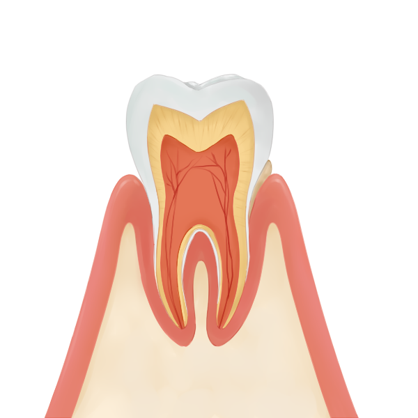 1.歯肉炎