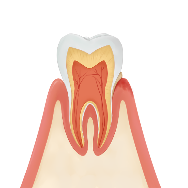 2.歯周炎