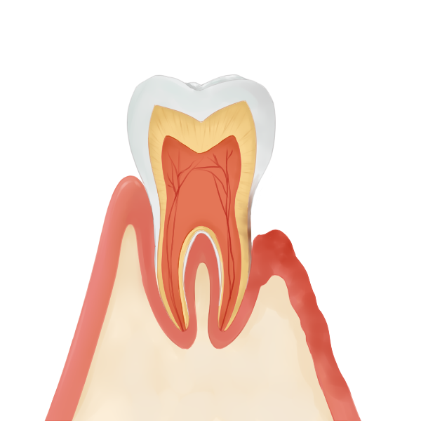 3.歯周炎(重度)
