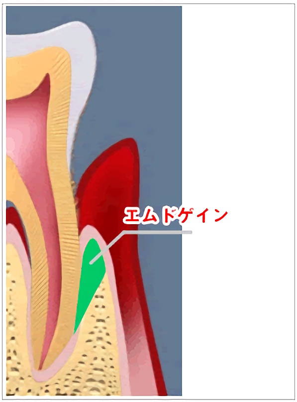 エムドゲイン法