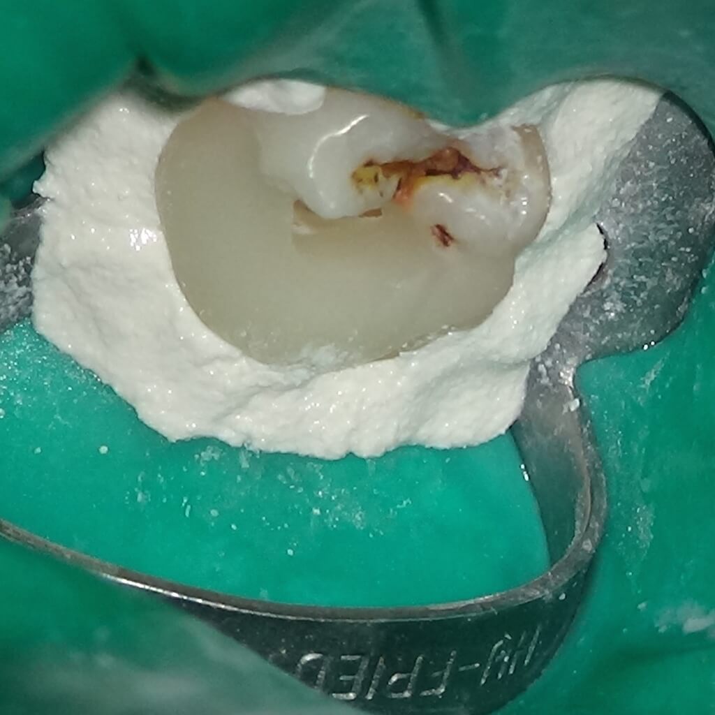 根管治療 隔壁周縁封鎖