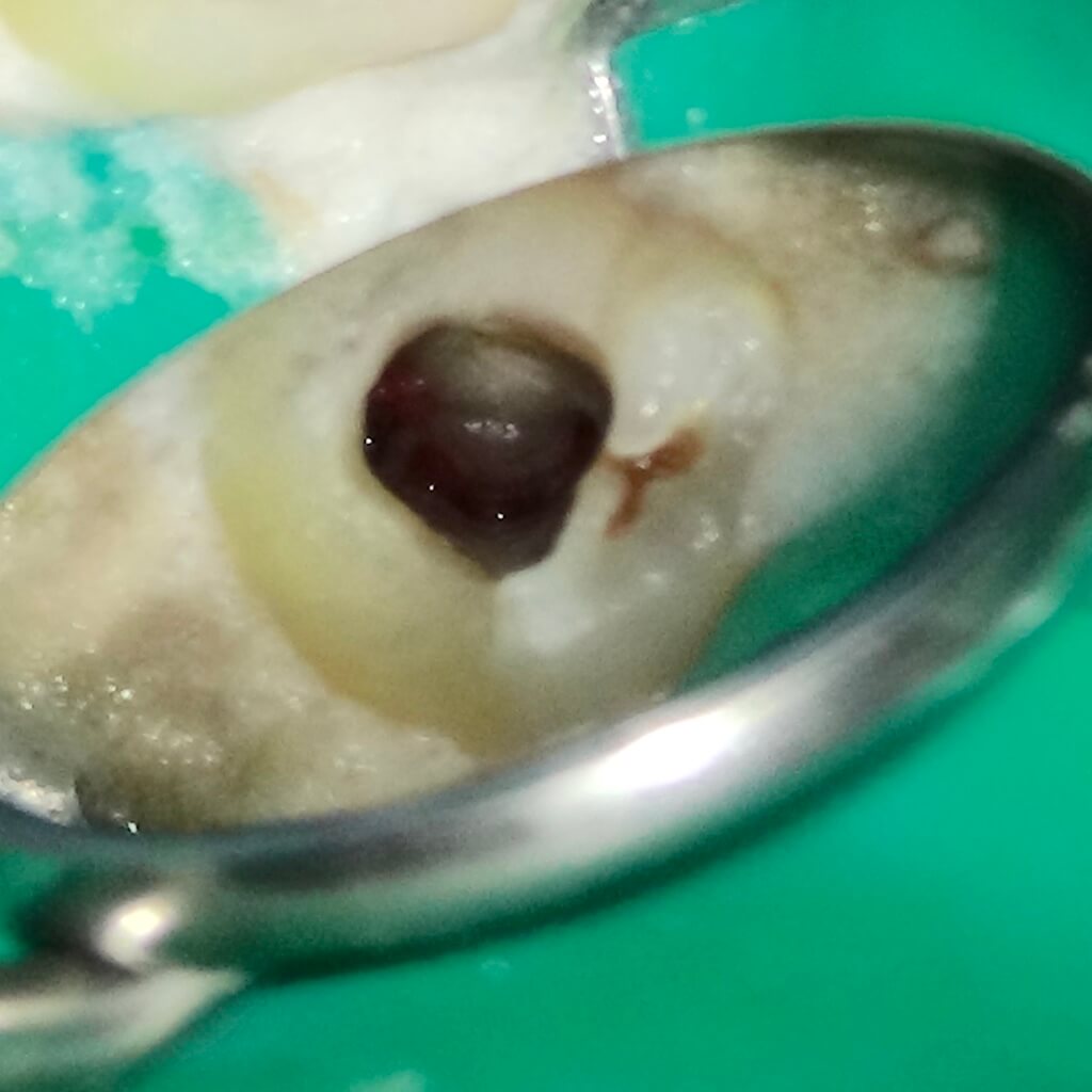 根管治療 根管治療開始
