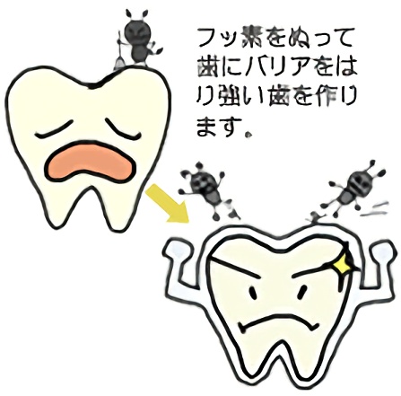 フッ素塗布による予防